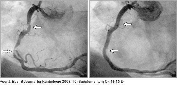 Koronarangiographie - Stenose - Stent