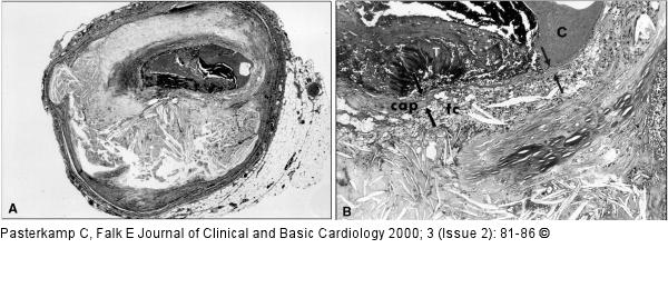 Plaqueverteilung und Thrombose