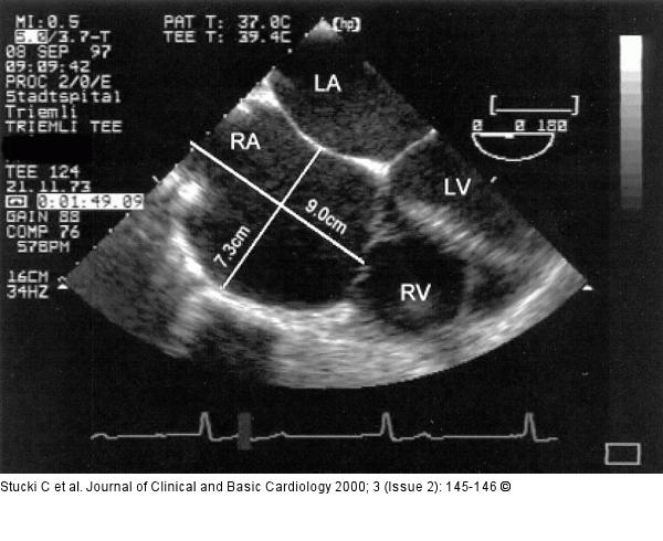 Emery-Dreifuss Muskeldystrophie - Kardiopathie
