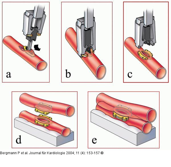 Anastomosendevices