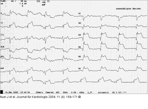Akutes Koronarsyndrom - Stenose der linken Herzkranzarterie