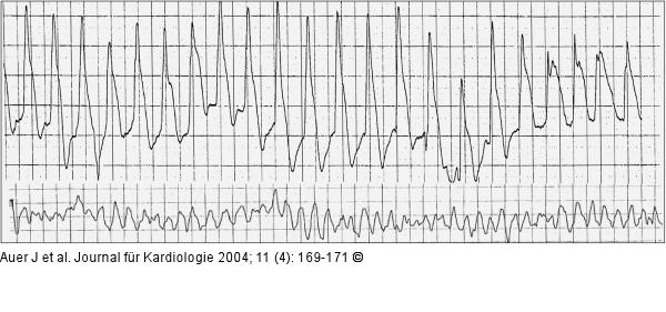 Akutes Koronarsyndrom - Stenose der linken Herzkranzarterie