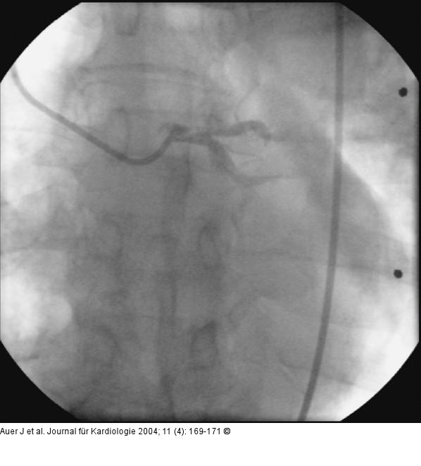 Akutes Koronarsyndrom - Stenose der linken Herzkranzarterie