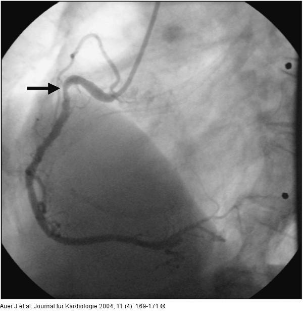 Akutes Koronarsyndrom - Stenose der linken Herzkranzarterie