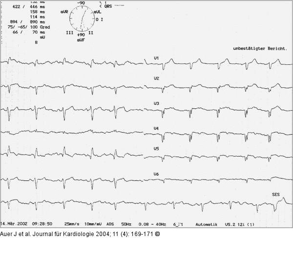 Akutes Koronarsyndrom - Stenose der linken Herzkranzarterie
