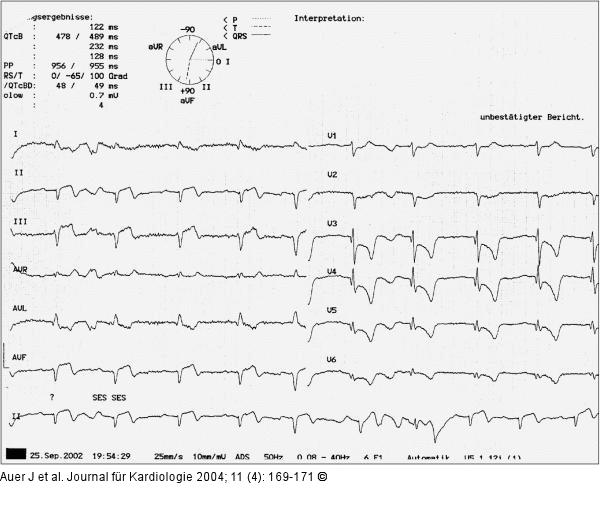 Akutes Koronarsyndrom - Stenose der linken Herzkranzarterie