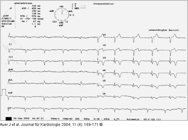 Akutes Koronarsyndrom - Stenose der linken Herzkranzarterie