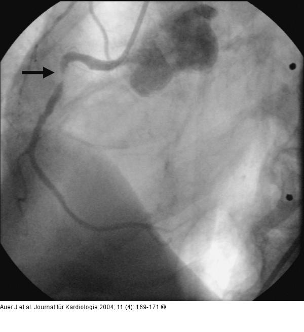 Akutes Koronarsyndrom - Stenose der linken Herzkranzarterie