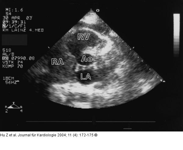 Tumorpropagation in den rechten Ventrikel