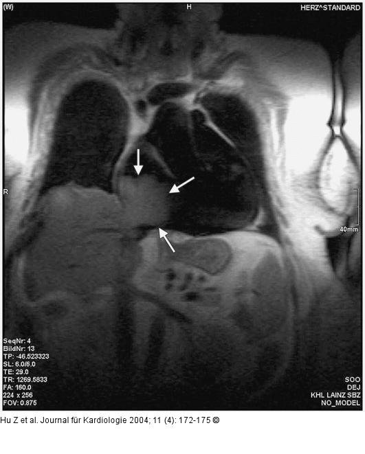 Tumorpropagation in den rechten Ventrikel