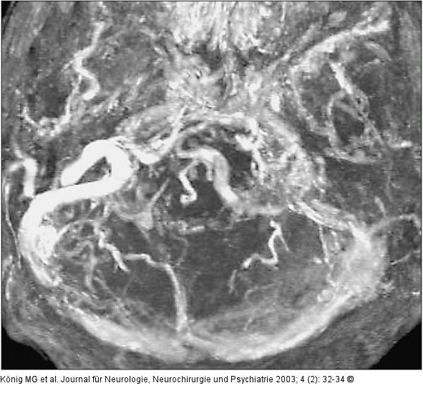 Sinus sigmoideus - Rekanalisation