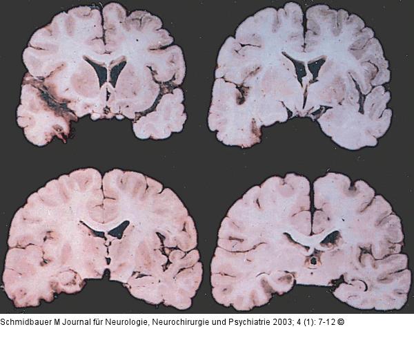 Temporallappenenzephalitis