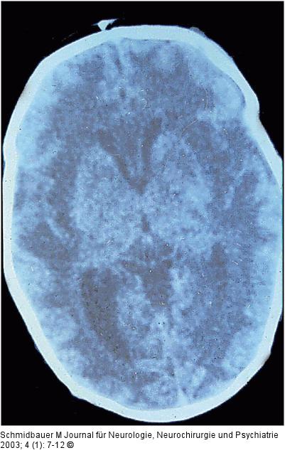 Herpes simplex - Enzephalitis