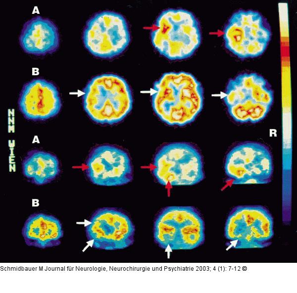 Temorallappenenzephalitis - Läsionen