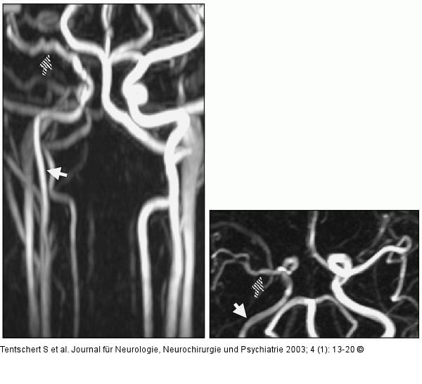Arteria carotis - Perfusion