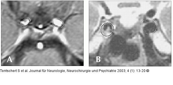 Arteria carotis - Dissektion