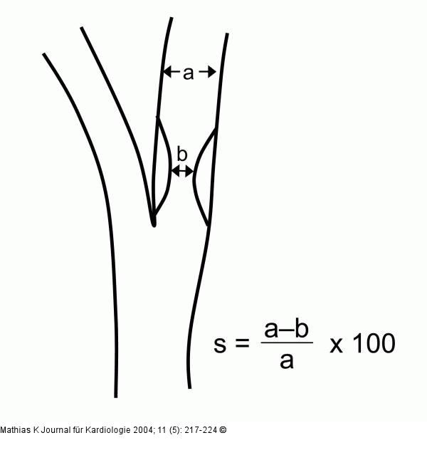 Stenosegrad - NASCET