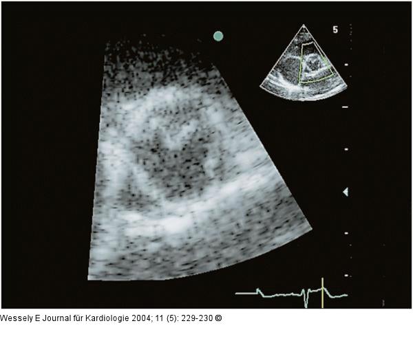 Membranöse Subaortenstenose