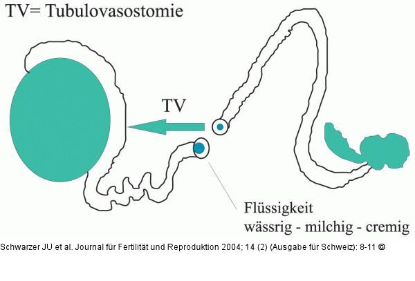 Samenwegsobstruktion