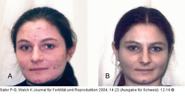 Akne vulgaris - Behandlung