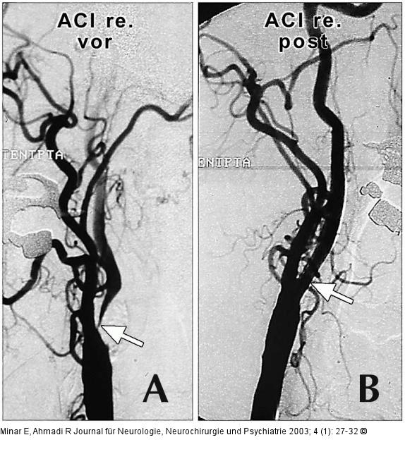 Arteria carotis - Stenose - Stent