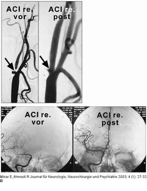 Arteria carotis - Stenose - Stent