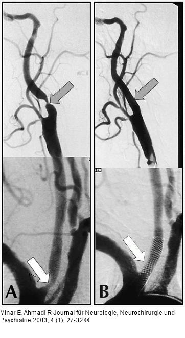 Arteria carotis - Stenose - Stent