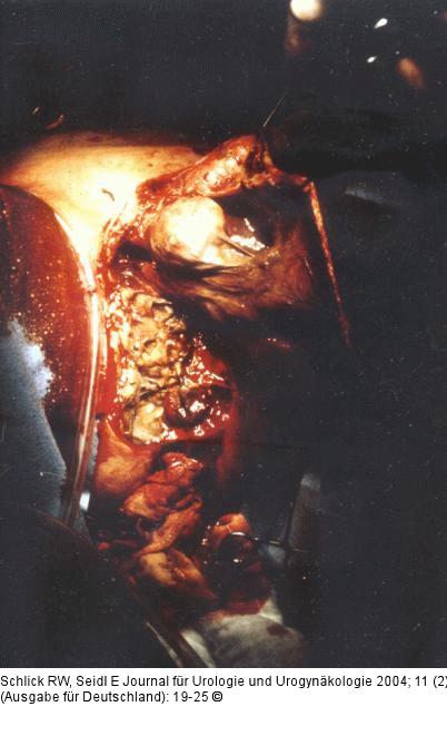 Fournier'sche Gangrän