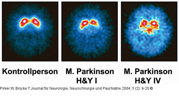Morbus Parkinson - SPECT
