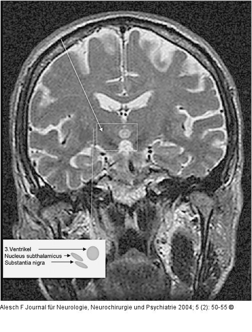 Morbus Parkinson - Nucleus subthalamicus