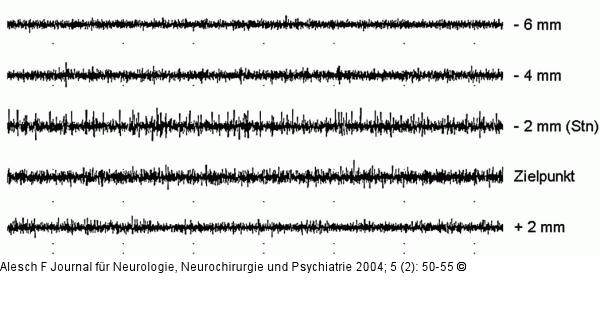 Tiefe Hirnstimulation - Elektrodenimplantation