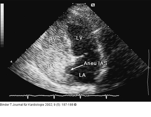 Interatriales Septum - Aneurysma