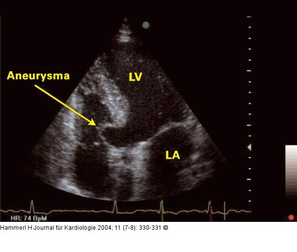Interventrikuläres Septum - Aneurysma