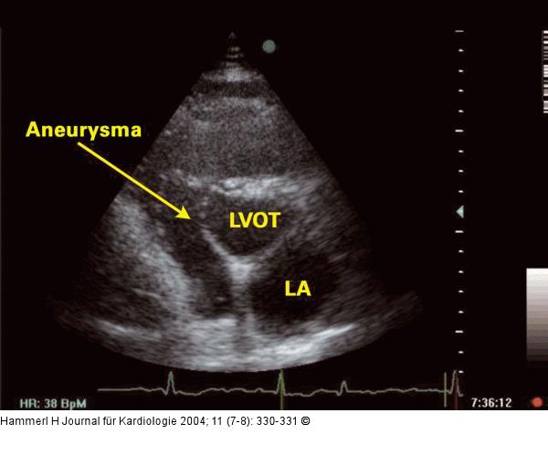 Interventrikuläres Septum - Aneurysma