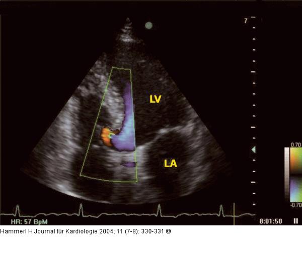 Interventrikuläres Septum - Aneurysma