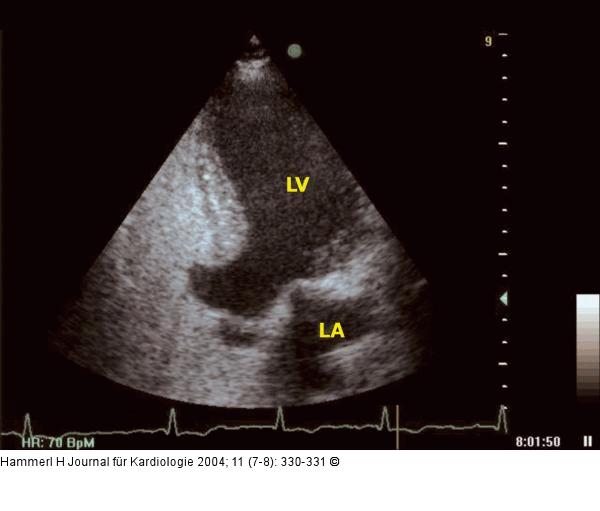 Interventrikuläres Septum - Aneurysma
