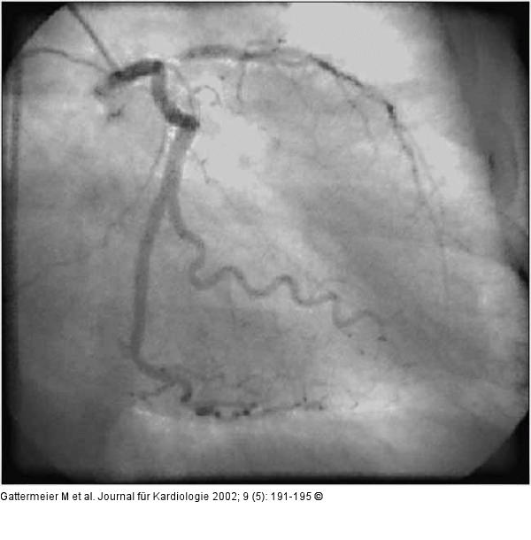 Subakute Stentthrombose - Fallbericht