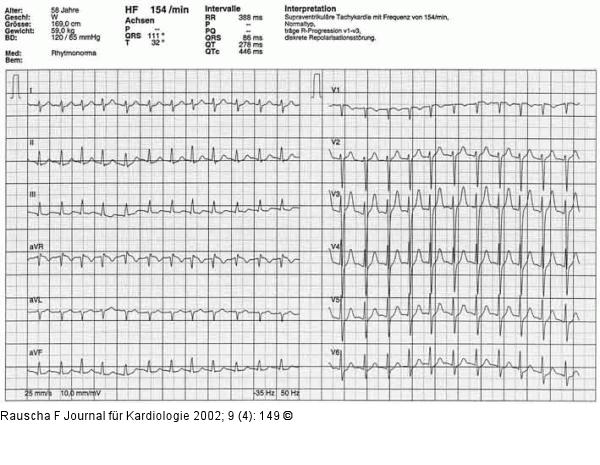 Supraventrikuläre Tachykardie