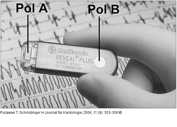 Implantierbarer Loop-Rekorder