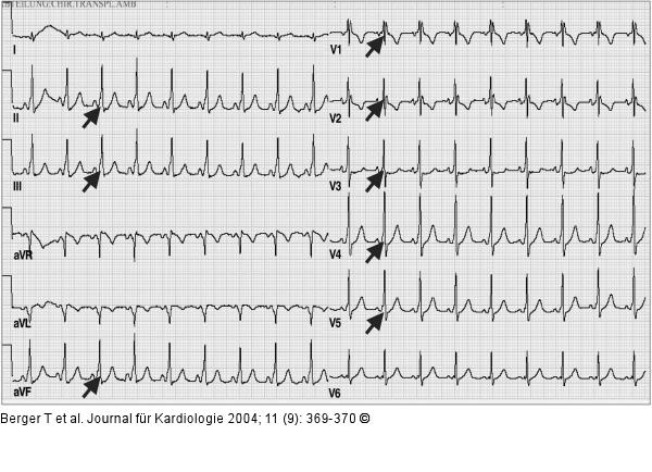 Paroxysmale Tachyarrhythmie