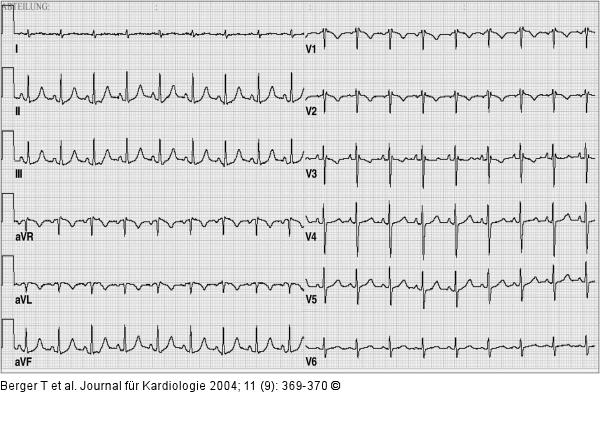 Paroxysmale Tachyarrhythmie
