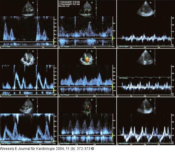 Diastolische Compliancestörung