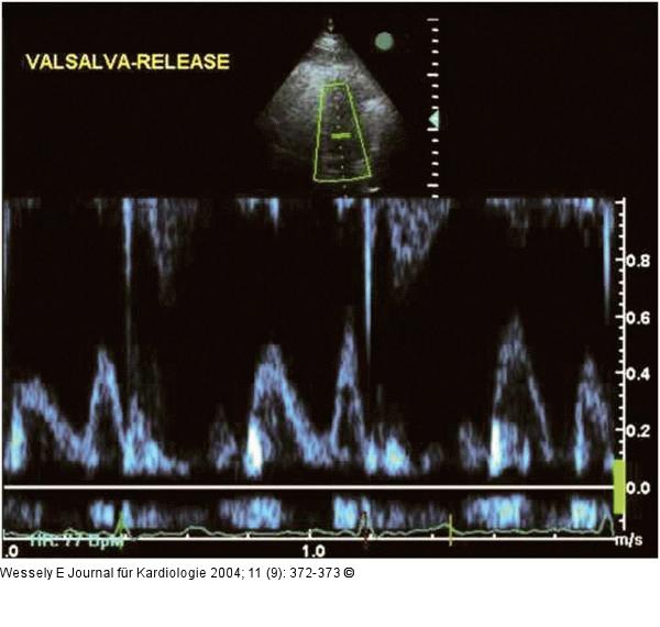Diastolische Compliancestörung