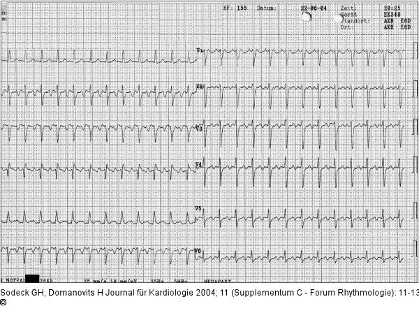 Rhythmische Schmalkomplextachykardie