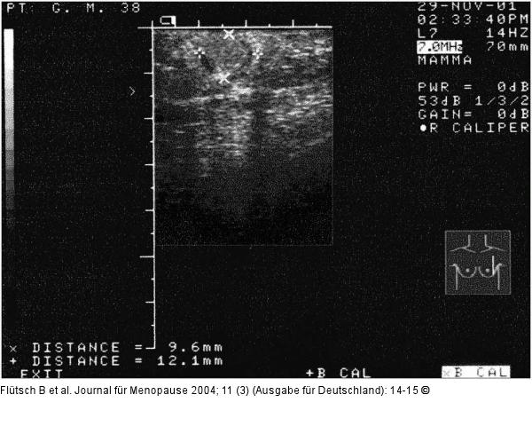 Mammographie - Knoten