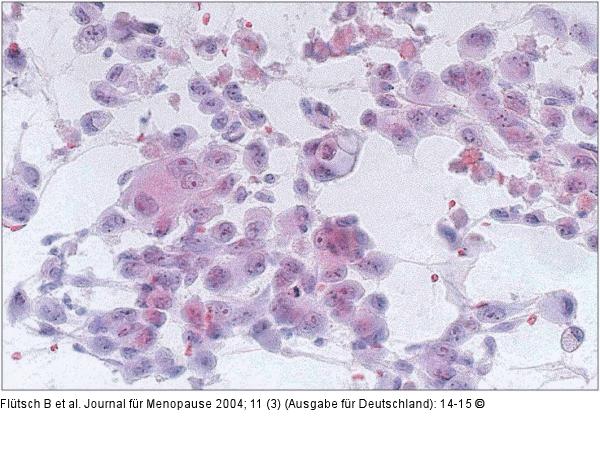 Feinnadelpunktion - Schilddrüsenkarzinom