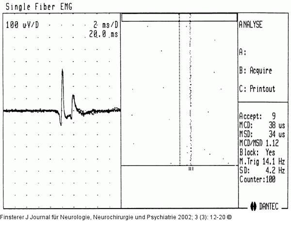 Einzelfaserelektromyographie