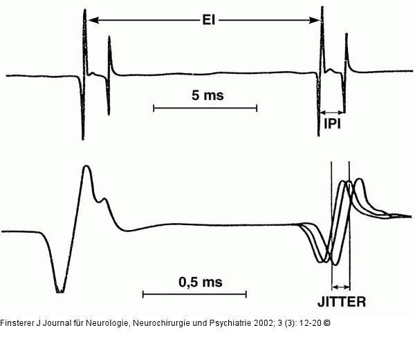 Einzelfaserelektromyographie