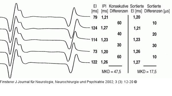 Einzelfaserelektromyographie