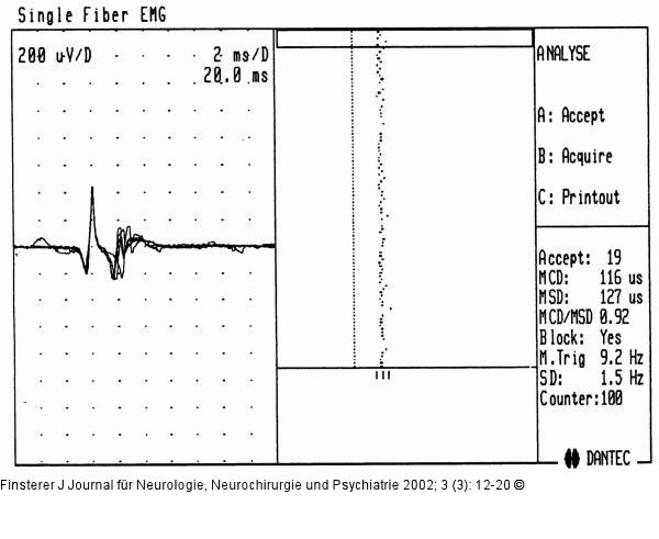 Einzelfaserelektromyographie - Myasthenia gravis